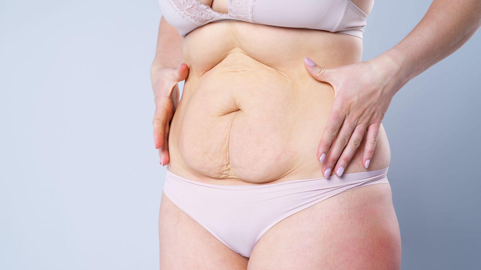 From Flab to Fab: The Ultimate Guide to Tummy Tuck Surgery!