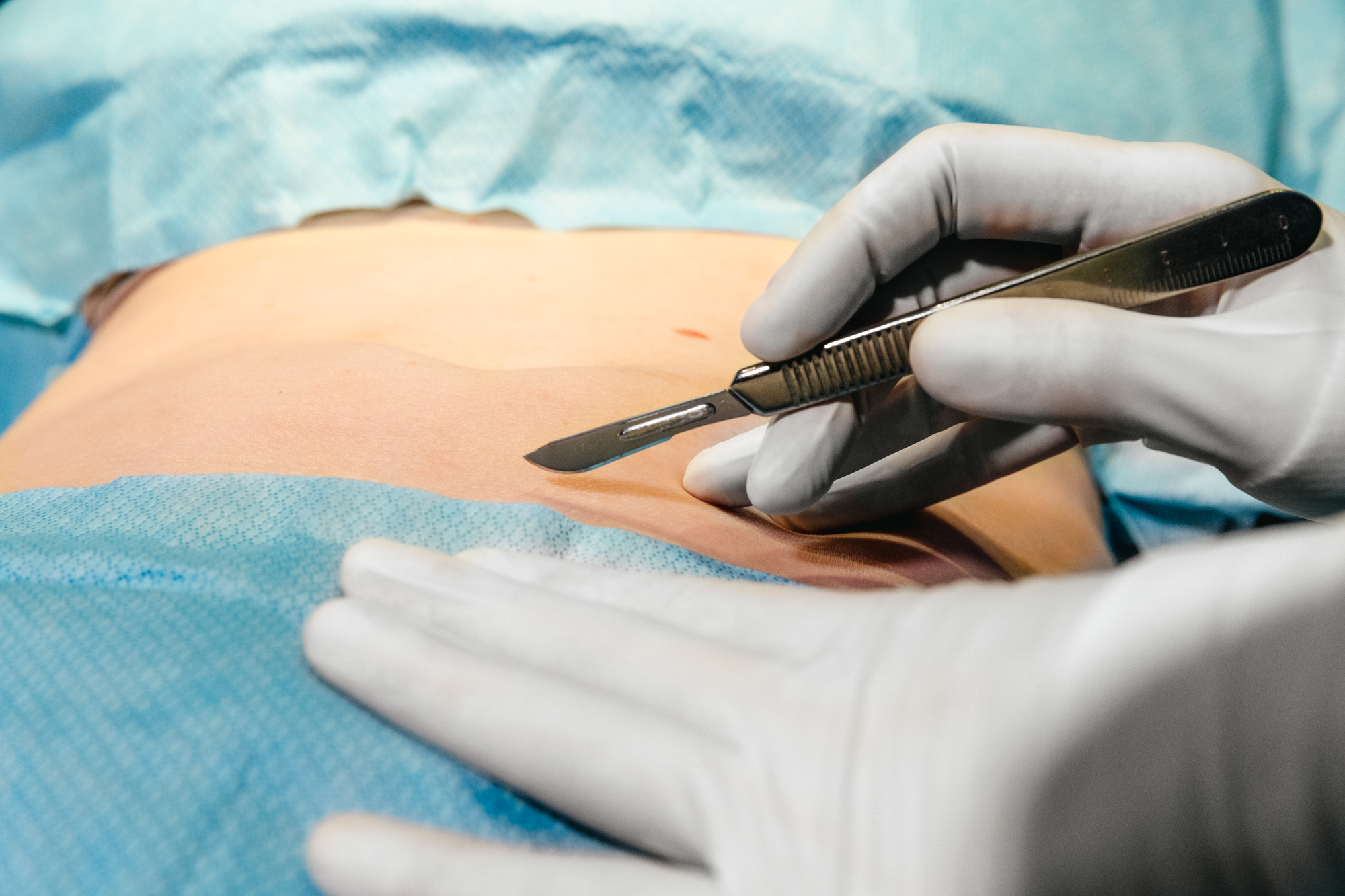 Mommy Makeover surgery