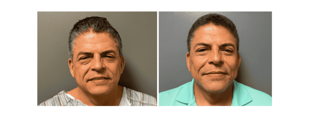 Two close-ups of a man's face showing the effects of a facelift near Brentwood, TN.