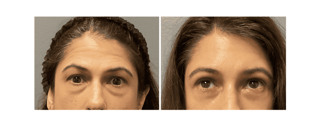 A close-up shot of a patient showing the results of a brow lift near Brentwood, TN