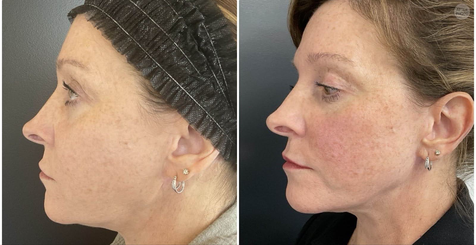 before and after photo of a woman's side profile after she received skin tightening in Nashville, TN with the morpheus8 device