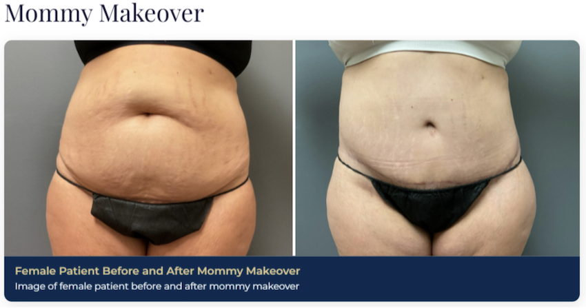 Alt Tex: A before-and-after of a patient's midsection post mommy makeover near Brentwood, TN. Her stomach is noticeably flatter and more contoured.