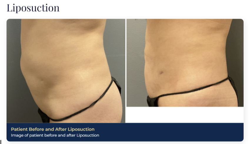 Before-and-after of a patient's stomach after their liposuction procedure. Liposuction is often used as part of a mommy makeover near Brentwood, TN, to improve the appearance.