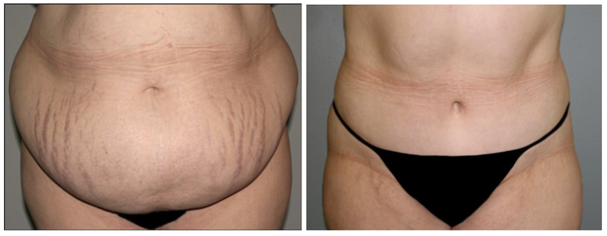 Before-and-after picture of a patient's stomach post abdominoplasty. This procedure is often used as part of a comprehensive mommy makeover near Brentwood, TN, plan.