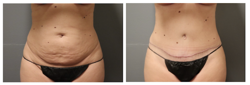 Before and After of a patient after their tummy tuck in Brentwood, TN. The abdominal area is visibly tighter and more toned.