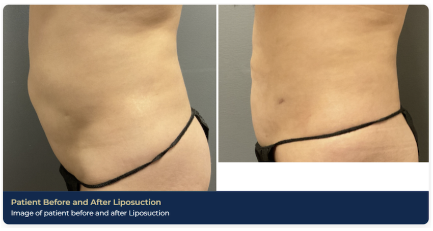 A before-and-after picture of a patient's abdomen from the side after liposuction. For some patients, liposuction is a better choice than a tummy tuck in Brentwood, TN.