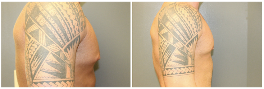 A before-and-after picture of a patient after his gynecomastia surgery in Nashville. There is a clear reduction in breast tissue between the two images.