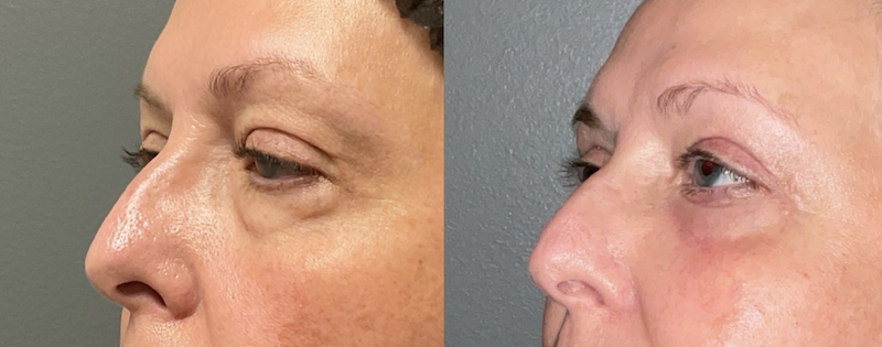 Before and after picture of a patient's blepharoplasty near Brentwood, TN. Her upper eyelids have less excess skin, making her eyes appear younger and brighter.