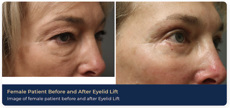 A before and after image of a patient's eye lift near Brentwood, TN. There is less excess skin on her upper and lower eyelids, making her eyes look younger and firmer.
