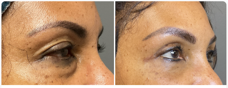  A before and after picture of a patient's blepharoplasty near Brentwood, TN. Both her upper and lower eyelids appear firmer, having less excess skin.