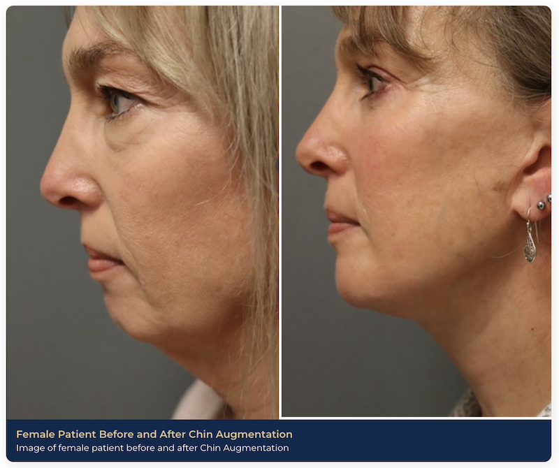 A before and after image of a patient's chin augmentation near Brentwood, TN. Her profile is more defined, with better facial balancing and harmony thanks to the chin augmentation.