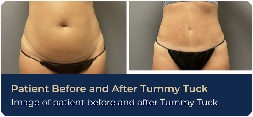 A patient's before and after photos post-tummy tuck. Tummy tucks are a common post-weight loss surgery in Nashville, and are used to tighten the midsection after weight loss. 