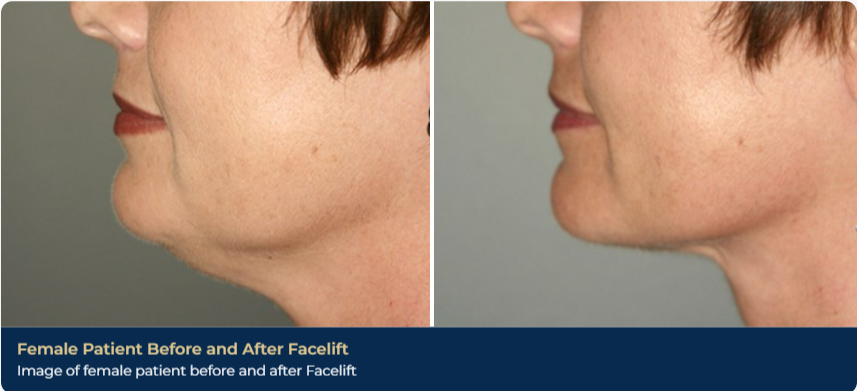 A before-and-after image of a patient's profile after a face lift in Brentwood, TN. There is a reduction in sagging skin under the chin, with tighter skin visible around the sides of the mouth and cheeks.