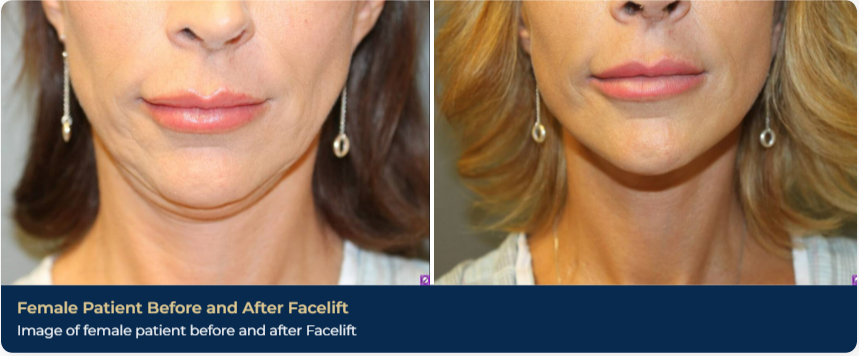 A before-and-after picture of a patient after a face lift in Brentwood, TN. There is noticeably less sagging skin around her chin and neck, with firmer skin around her cheeks.