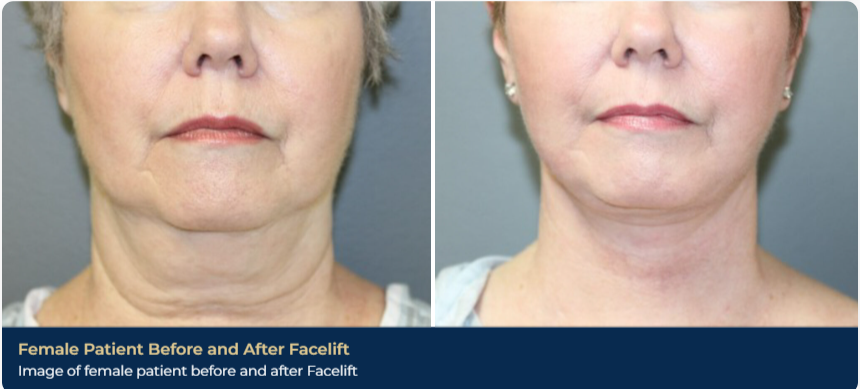 A before-and after image of a patient's results from a face lift in Brentwood, TN. The skin around her chin, neck, and cheeks is noticeably tighter, with less sagging and excess skin.