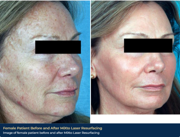 A before-and-after image of a patient's melasma treatment near Franklin, TN, using MiXto laser resurfacing. There is noticeably less pigmentation in her skin, and a clearer complexion.