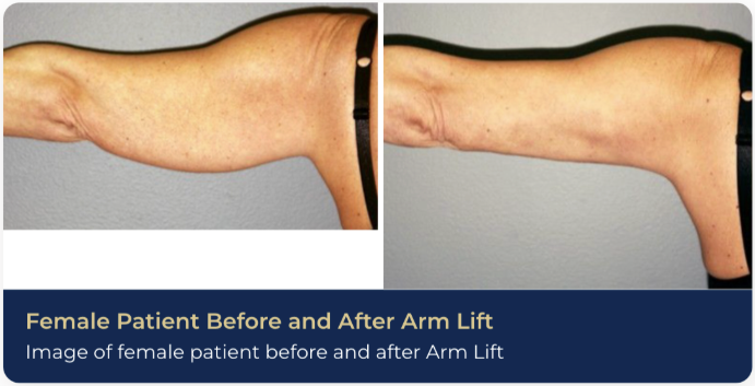 Before-and-after photo of a patient's results from an arm lift, which is often recommended to patients looking for the best skin tightening in Brentwood.