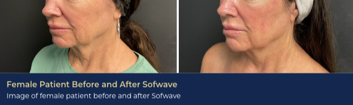 Before-and-after photo of a patient's results from Sofwave, which is often recommended to patients looking for the best skin tightening in Brentwood that is non-surgical.
